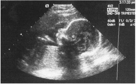 3d ultrasound pictures at 26 weeks. 3D ultrasound was first