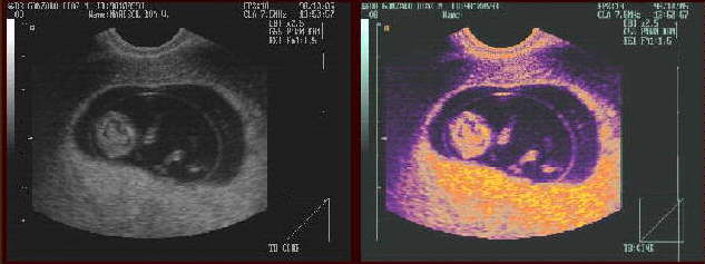 B-mode ultrasound gave us images