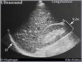 Normal liver ultrasound